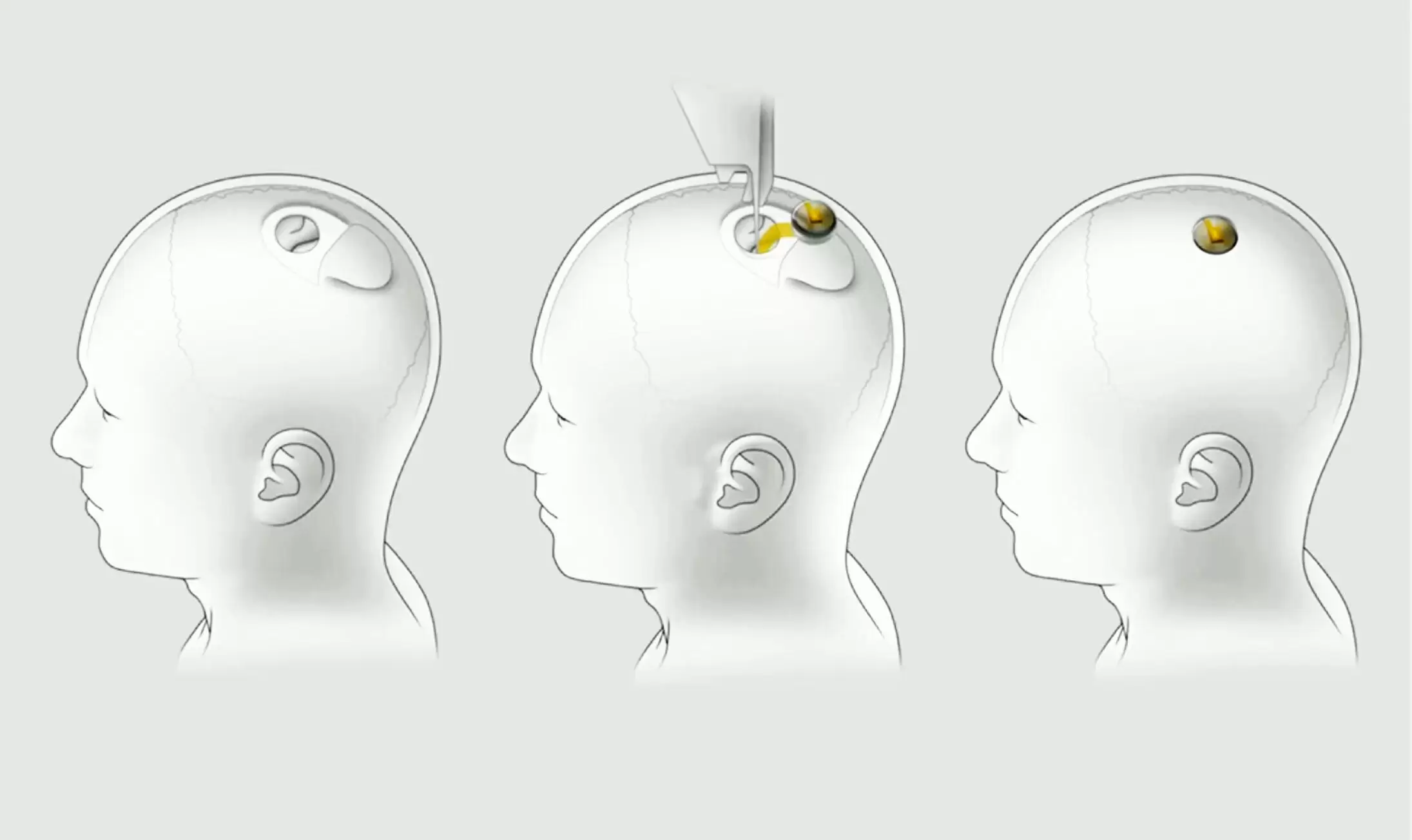 The Future of Neuralink: Elon Musk's Brain-Computer Interface Project